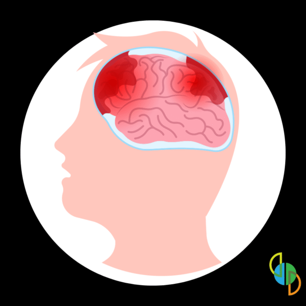 illustration showing concussion injury to the brain